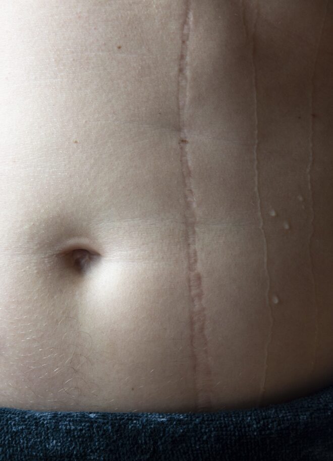 Detailfoto van een buik van een man waarop een verticaal litteken is te zien en waterdruppels - fotografie door Tamara De Prest